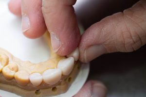 Prothèses dentaires conjointes
