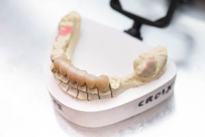 Prothèses dentaires conjointes